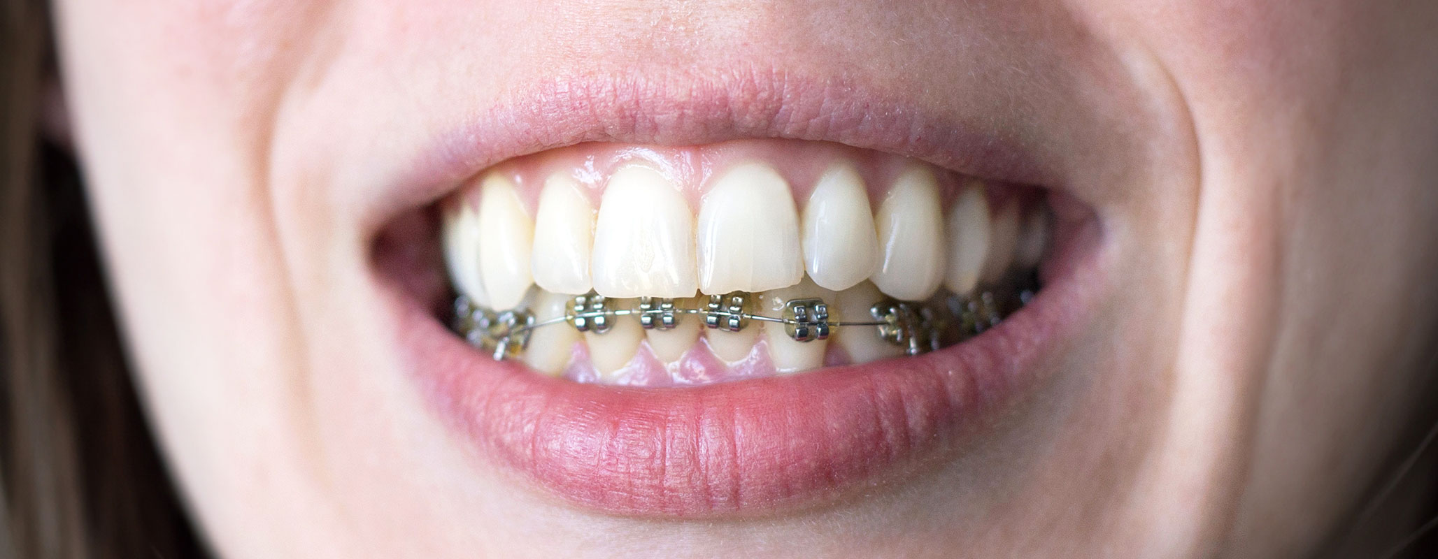 上の歯列のみ裏側にリンガルブラケット矯正装置をつける治療方法